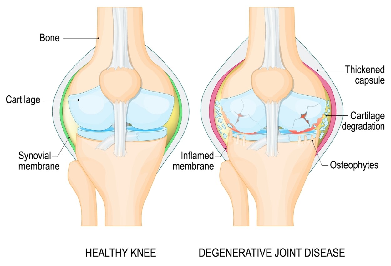 degenerative knee joint